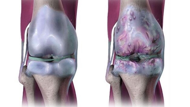 Sendi lutut yang sihat dan terjejas oleh arthrosis
