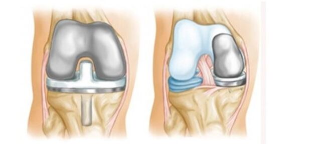 arthroplasty untuk arthrosis sendi lutut