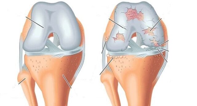 sendi sihat dan arthrosis sendi lutut
