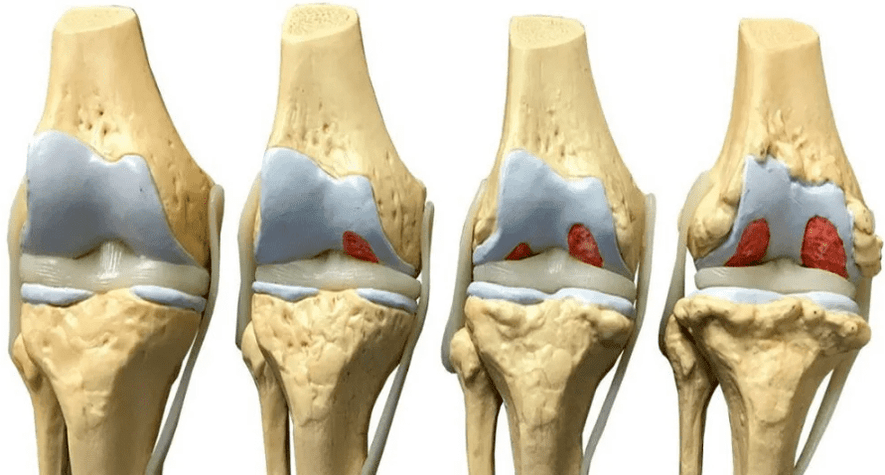 kerosakan pada sendi lutut pada peringkat perkembangan arthrosis yang berbeza