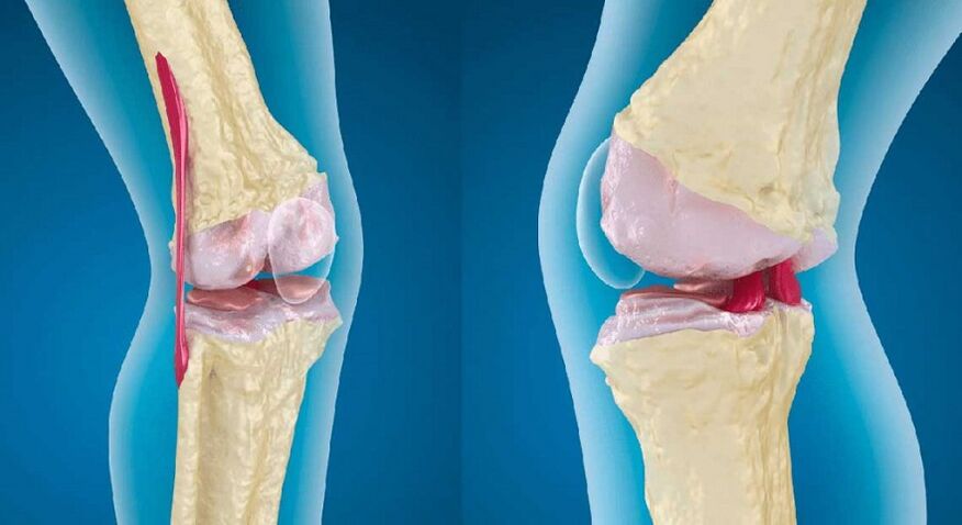 sendi sihat dan arthrosis sendi lutut