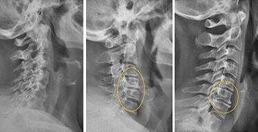 gambar tulang belakang serviks untuk diagnosis