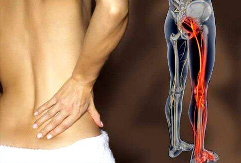 sakit belakang bawah akibat keradangan saraf sciatic