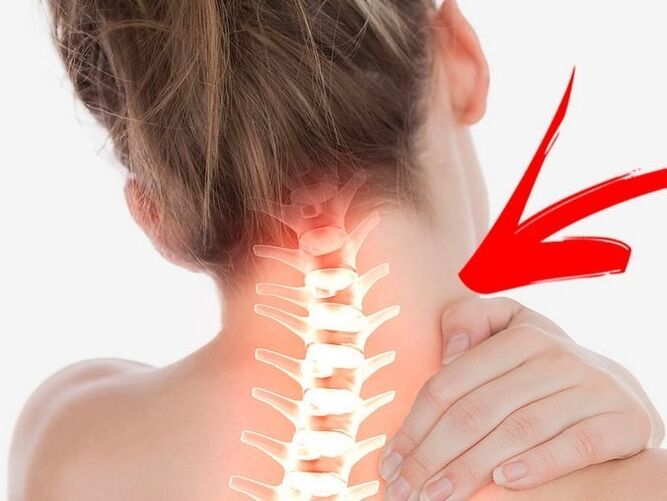 Mampatan akar saraf dengan osteochondrosis serviks