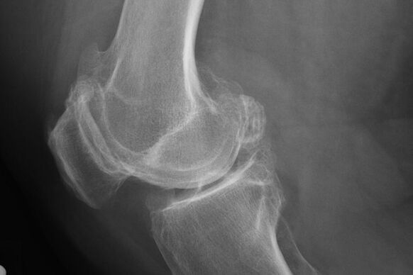 Kaedah untuk mendiagnosis arthrosis lutut