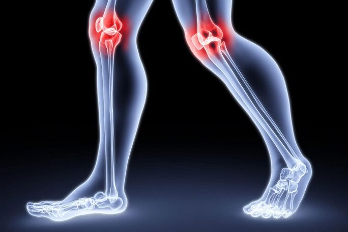 sakit lutut akibat arthritis dan arthrosis