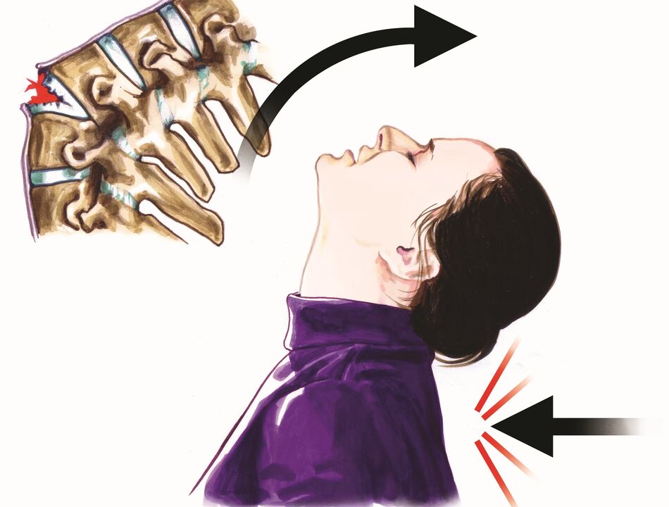 kerosakan tulang belakang sebagai punca sakit leher